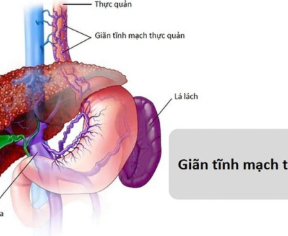 Nguyên nhân phổ biến nào gây ra xuất huyết tiêu hóa?